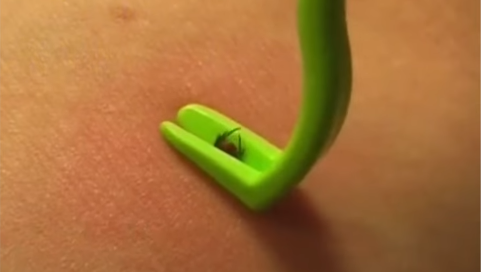 Removing Ticks Safely